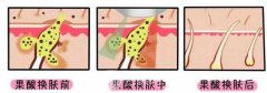 做果酸多少钱呢?