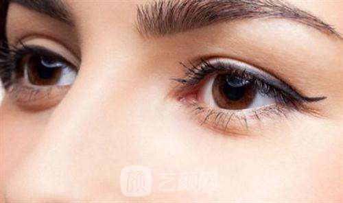 高分子埋线双眼皮能保持多久