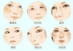 做了激光祛痣祛斑还有平时要注意什么能恢复的好？