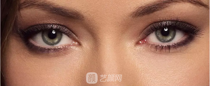 北京韩式开眼角多少钱?