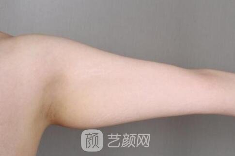 北京吸脂瘦手臂手术多少钱?