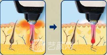 冷光量子脱毛有副作用吗?