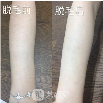 南京医院手臂激光脱毛价格多少钱?