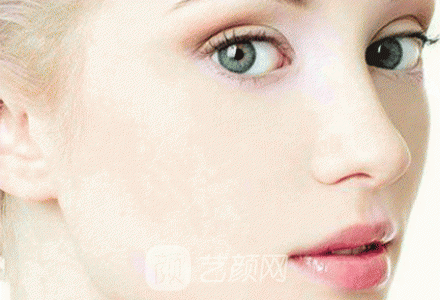 北京光子美容手术要多少钱?