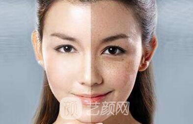 复合彩光和激光祛斑有什么区别