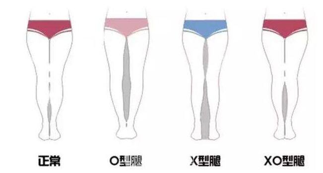 手术可以矫正O型腿吗?