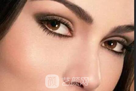 下眼睑整形的几点须知常识