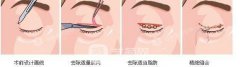双眼皮全切大概费用是多少呢？