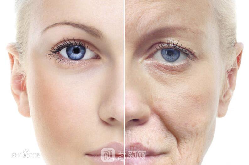 上眼皮松弛了，怎么办啊!