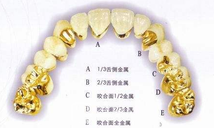 北京金钯合金烤瓷牙价格多少