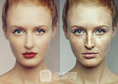 王著风范祛斑要做几次有果