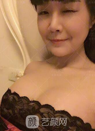 产后妈妈假体隆胸真实案例恢复过程