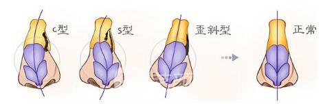 上海做歪鼻矫正大概要好多钱