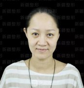 埋线提升提拉只是下垂的皮肤？不，更是我逝去的年华~