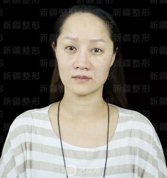 埋线提升提拉只是下垂的皮肤？不，更是我逝去的年华~