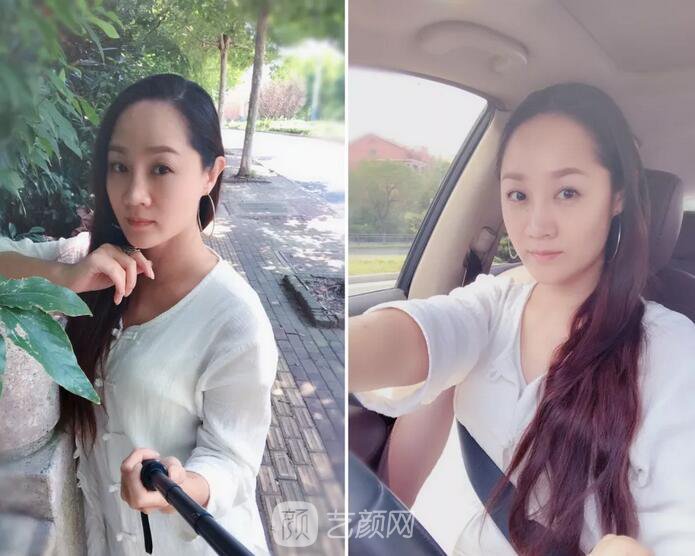埋线提升提拉只是下垂的皮肤？不，更是我逝去的年华~