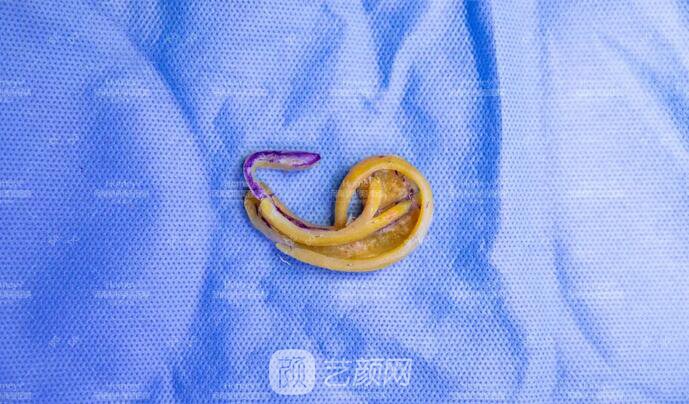 【取肋软骨会影响孩子胸廓发育吗？】