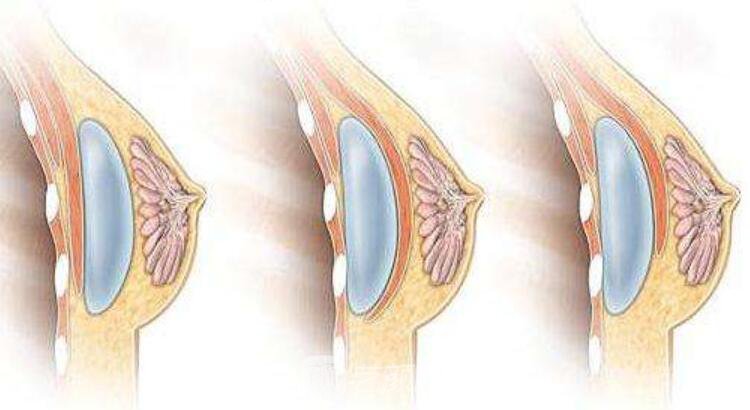 【选择隆胸手术都有哪些原因】