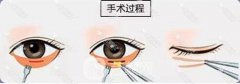 睑外翻矫正的费用怎样，影响因素有哪些?