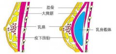 “平胸妹纸”隆胸一般要花多少钱?