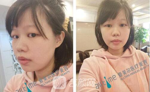 福州爱美尔王*全切双眼皮真实案例