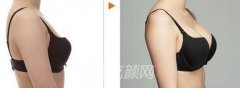 2019春季整形深圳隆胸价格一览