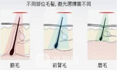 2019春季上海光子脱毛价格是多少?