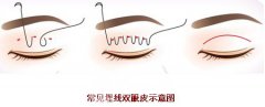 高分子埋线双眼皮大致价位是多少 影响的因素有哪些?