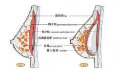 复合假体丰胸是*有的隆胸方式吗???