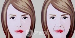 自身细胞移植术怎么样，自体脂肪都是宝~