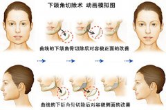深圳面部轮廓整形多少钱?