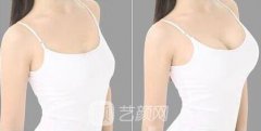 杭州自体脂肪隆胸多少钱?