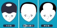 同是毛发移植，价格为何有差距?