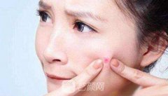 祛痘印的价格什么因素影响~
