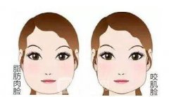 咬肌大怎么办，去除需要多少钱?