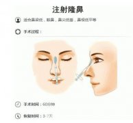 太原丽都玻尿酸注射隆鼻费用~