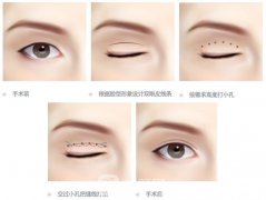 辽阳双眼皮手术多少钱?