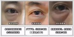 祛眼袋手术让你眼睛电力十足，成为实力“眼”技派！