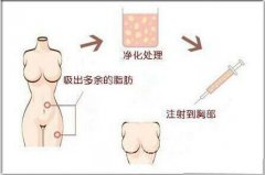 广州自体脂肪隆胸费用多少?