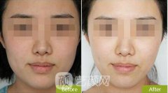 光纤溶脂价格贵不贵，有没有什么后遗症?