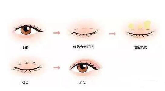 肿眼泡如何做双眼皮