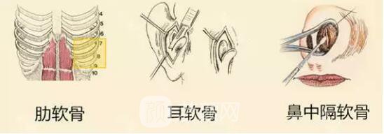 做鼻尖手术有哪些材料​