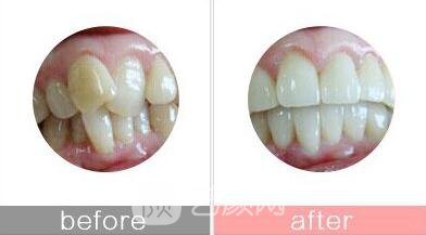 学生牙齿正畸要“赶早”