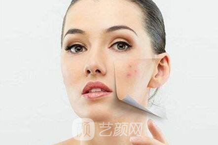 长痘痘了饮食方面应该如何注意呢