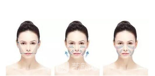 面部埋线提升帮你抓住青春的小尾巴