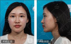 北京美莱鼻梁注射玻尿酸果 前后照片案例