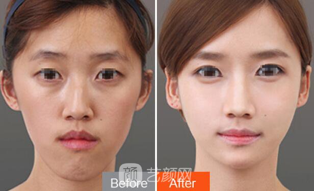 做假体隆鼻为什么受欢迎 重塑鼻部的挺拔