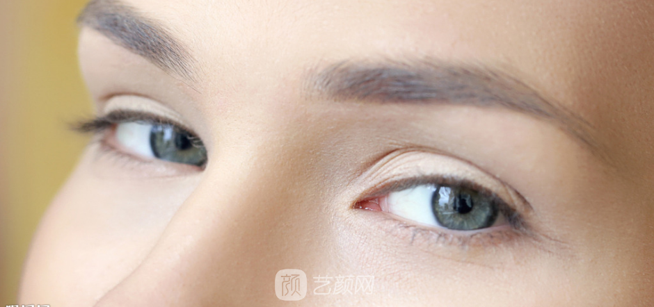 告别20年的单眼皮 双眼皮去皮去脂