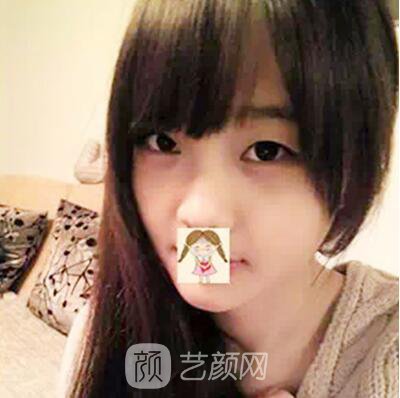 我做的埋线也挺自然的~~有图有真相