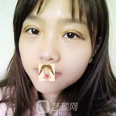 我做的埋线也挺自然的~~有图有真相